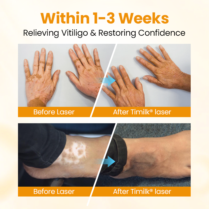 Timilk® VitiGone Rapid Spray — 2–3 Week Repigmentation with OTDS 😃