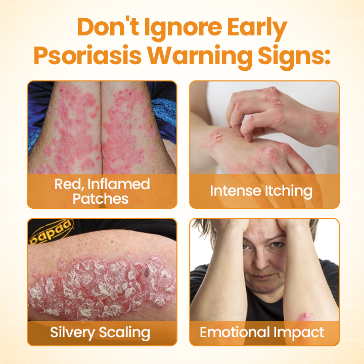 TimilkĀ®BeeLieve Psoriasis Skin Care š„