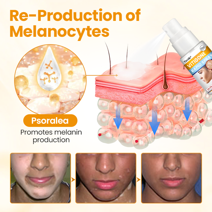 Timilk® VitiGone Rapid Spray — 2–3 Week Repigmentation with OTDS 😃