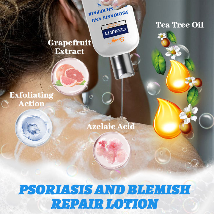 Ceoerty® Psoriasis and Blemish Repair Lotion 🔥