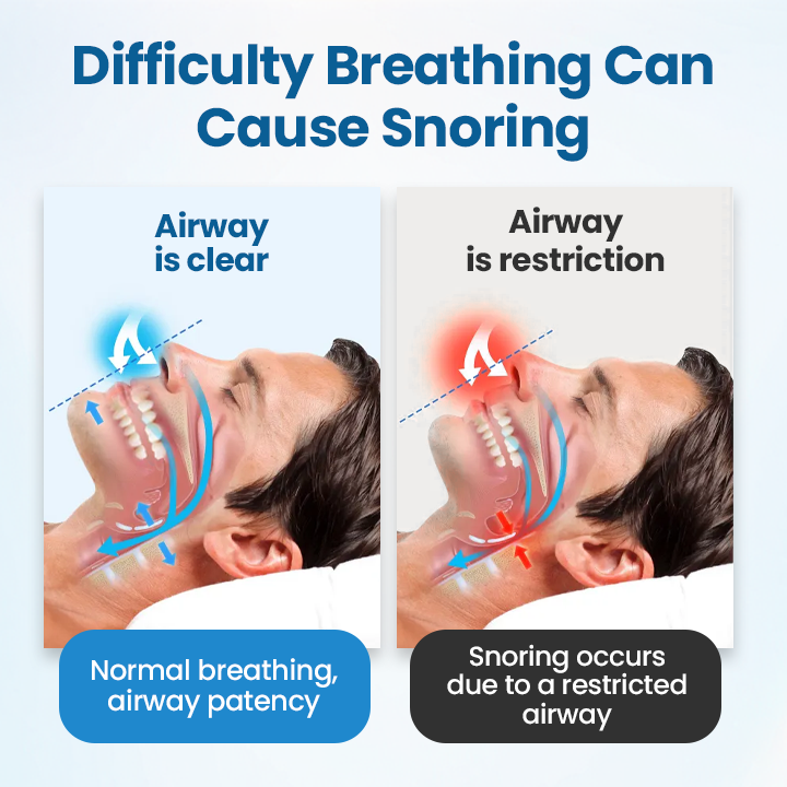 Timilk® SnoreLess Nasal Breather