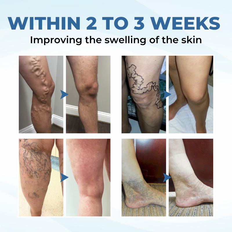 Timilk® TheraVein Varicose Herbal Spray