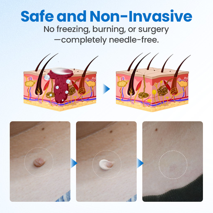 Timilk® TagGone Wart Removal Cream