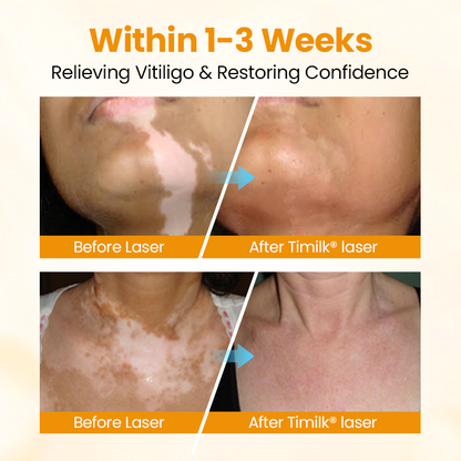 Timilk® VitiGone Rapid Spray — 2–3 Week Repigmentation with OTDS 😃