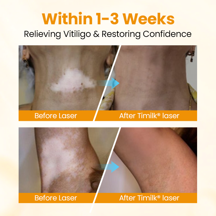 Timilk® VitiGone Rapid Spray — 2–3 Week Repigmentation with OTDS 😃