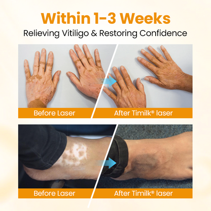 Timilk® VitiGone Rapid Spray — 2–3 Week Repigmentation with OTDS 😃