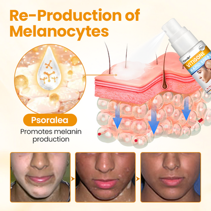 Timilk® VitiGone Rapid Spray — 2–3 Week Repigmentation with OTDS 😃