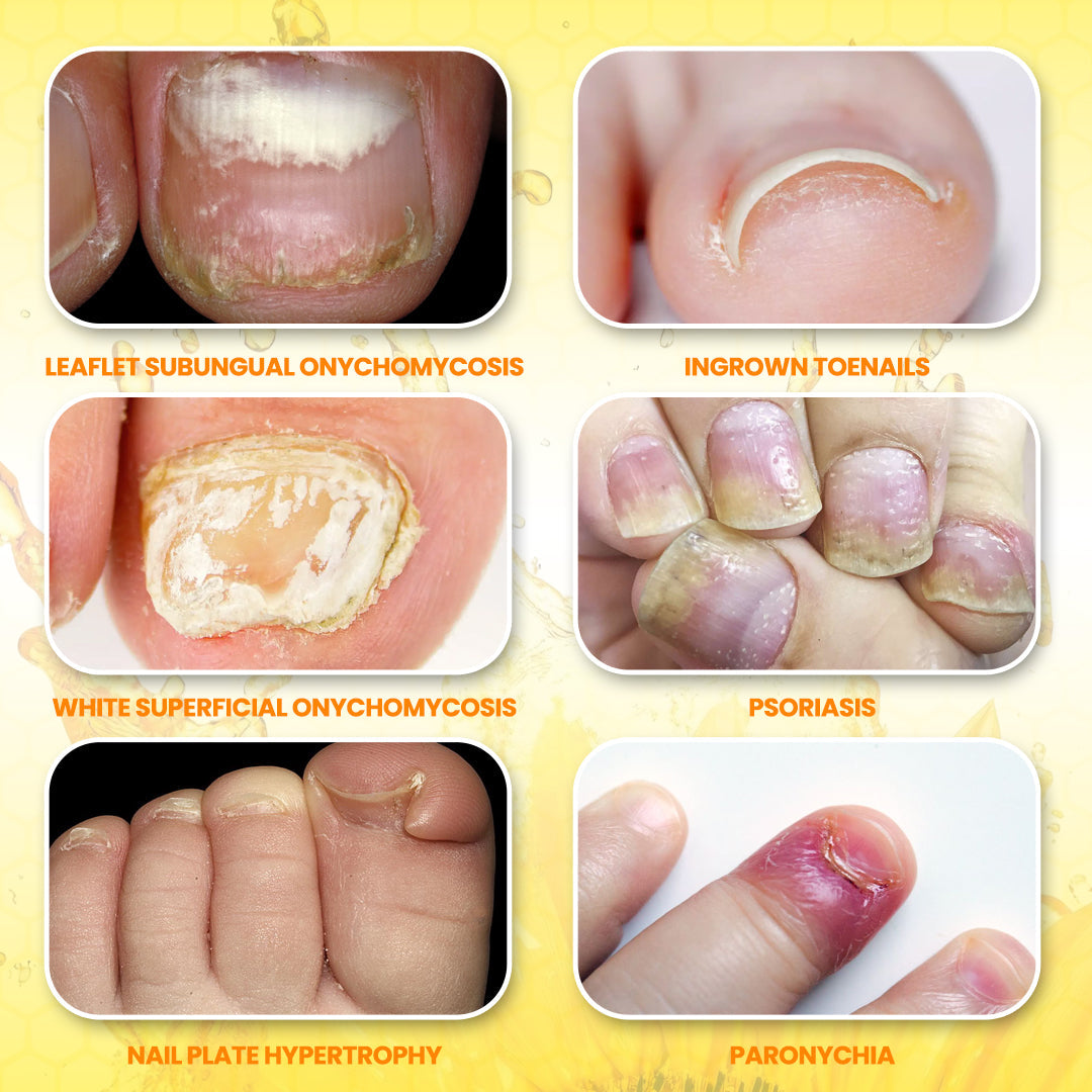 Timilk® ClariNail Bee Venom Fungal Solution Drops