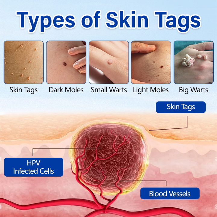 Timilk® WartClear Herbal Ointment🇺🇸