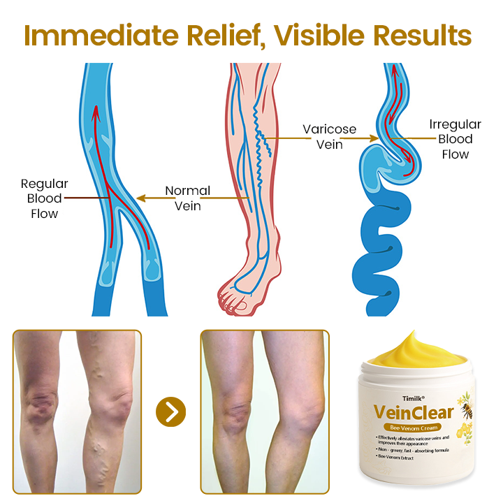 Timilk® VeinClear Bee Venom Cream |✨ Visible Relief in Just 7 Days! 🦵🌿