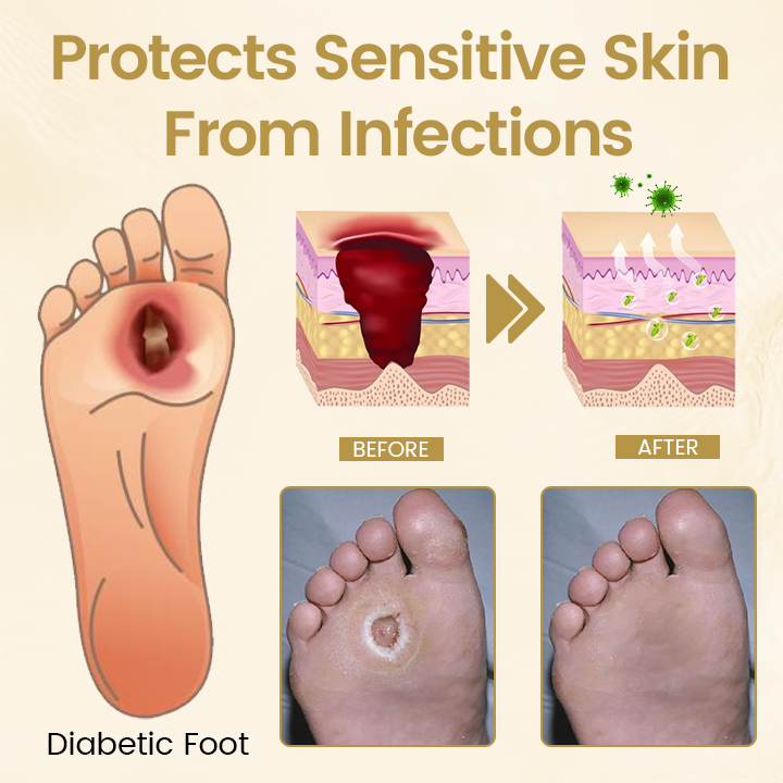 Timilk® Diabetic Foot Healing Spray - Bee Venom Infused