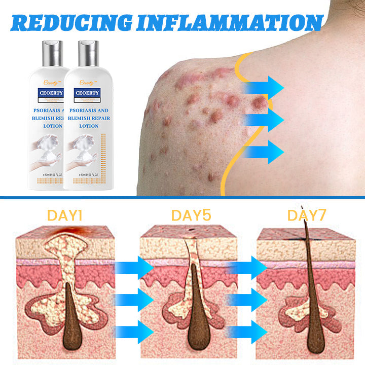 Ceoerty® Psoriasis and Blemish Repair Lotion 🔥