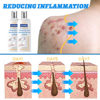 Ceoerty® Psoriasis and Blemish Repair Lotion 🔥