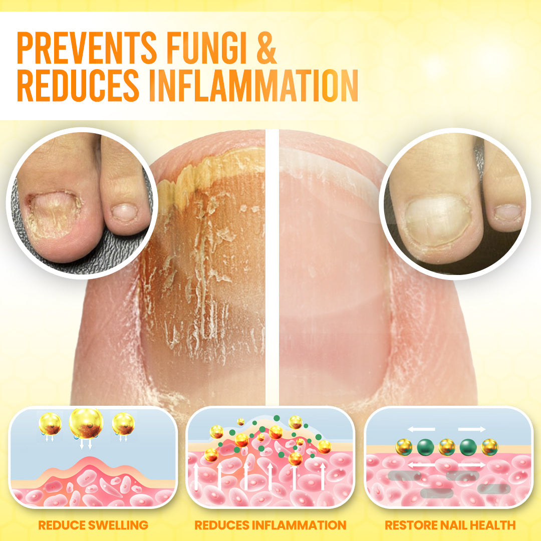 Timilk® ClariNail Bee Venom Fungal Solution Drops