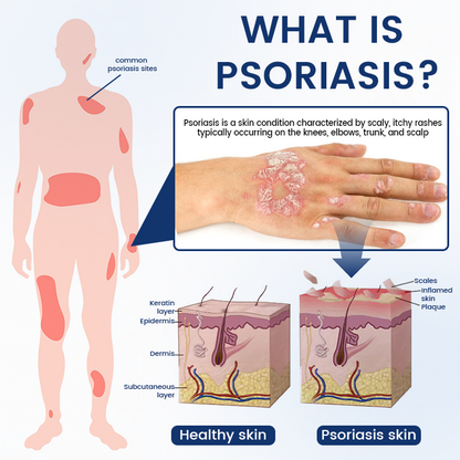 Timilk® PsoriCure Magnesium Herbal Spray