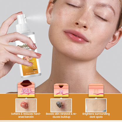 Timilk® BeeVenom Wart Renewal Spray 🇺🇸