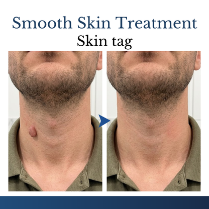 Biancat® DermFixPro 2-in-1 Microneedle & Hydrocolloid Patch