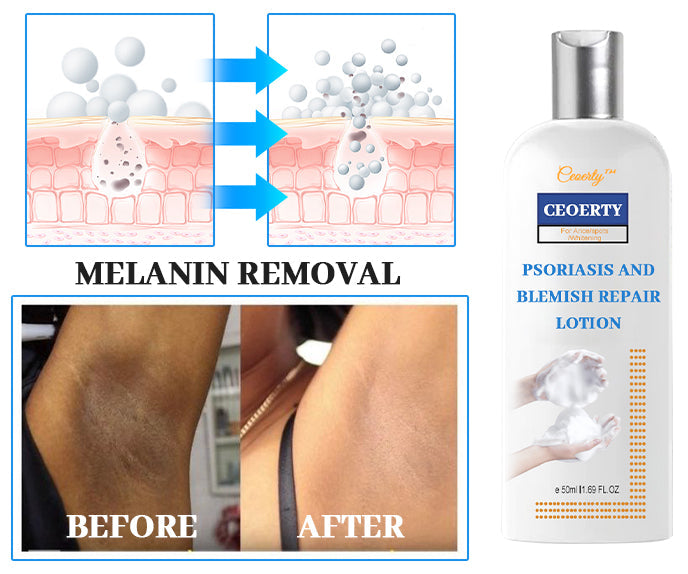 Ceoerty® Psoriasis and Blemish Repair Lotion 🔥