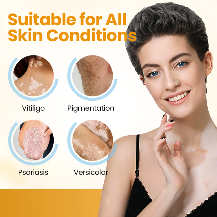 Timilk® VitiGone Rapid Spray — 2–3 Week Repigmentation with OTDS 😃